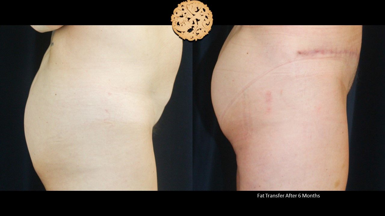 Brazilian Butt Lift Before & After