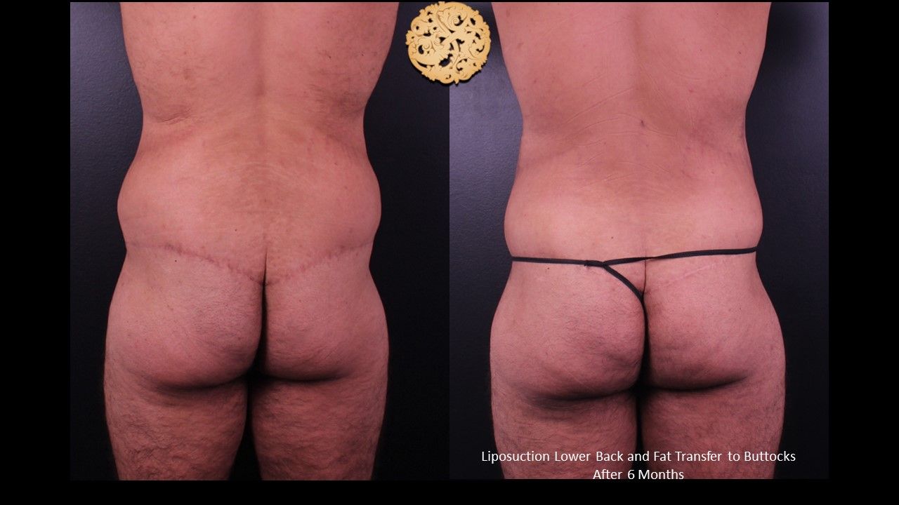 Brazilian Butt Lift Before & After