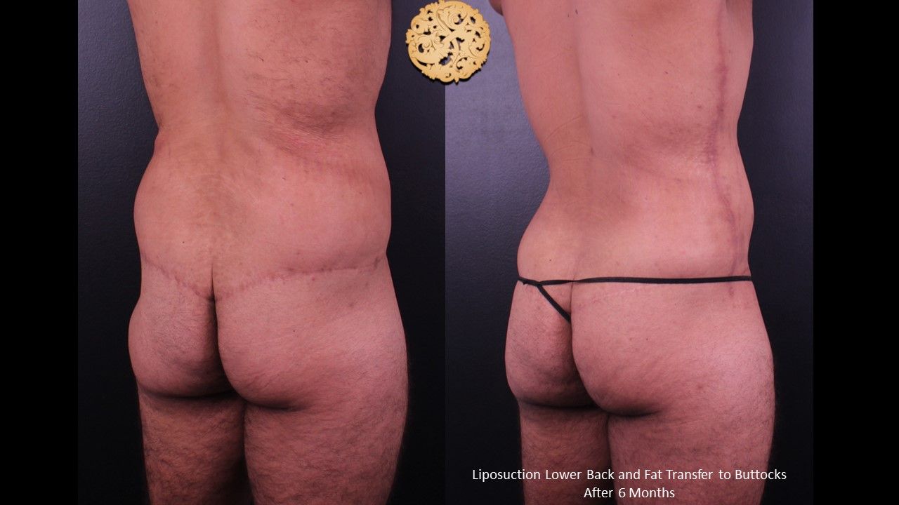 Brazilian Butt Lift Before & After