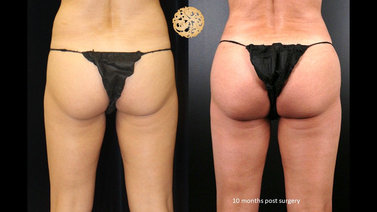 Brazilian Butt Lift Before & After