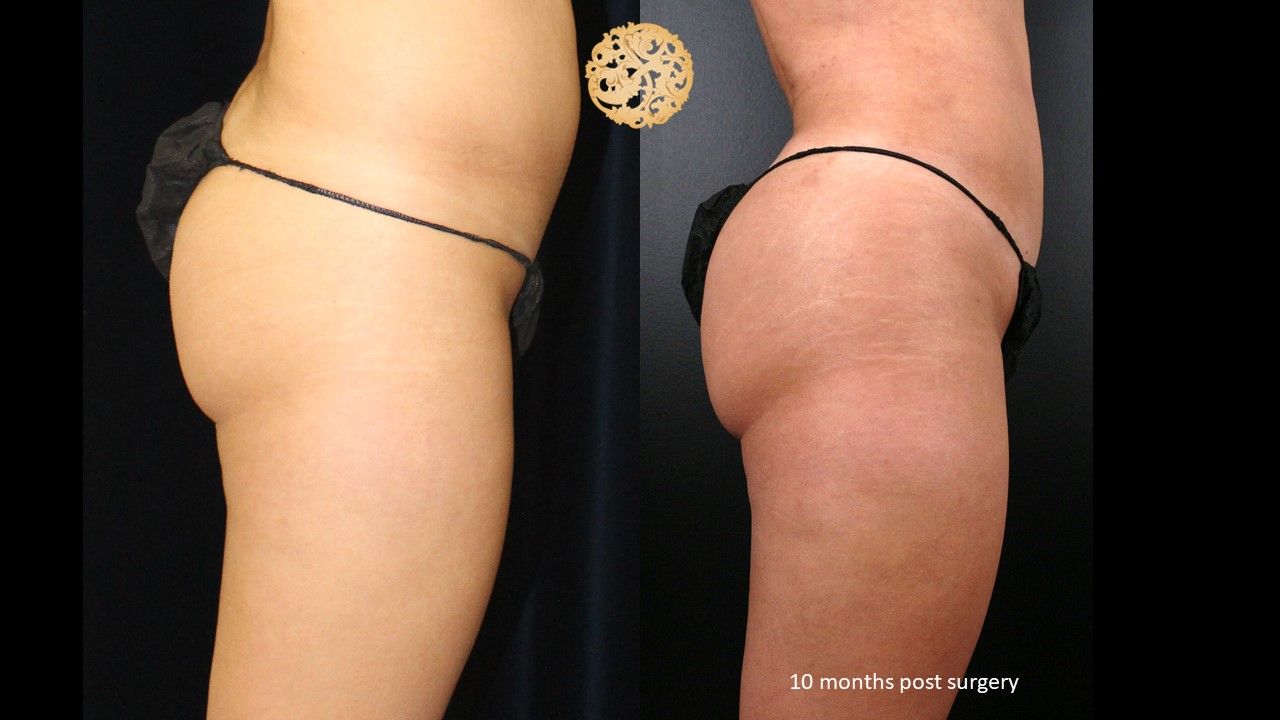 Brazilian Butt Lift Before & After
