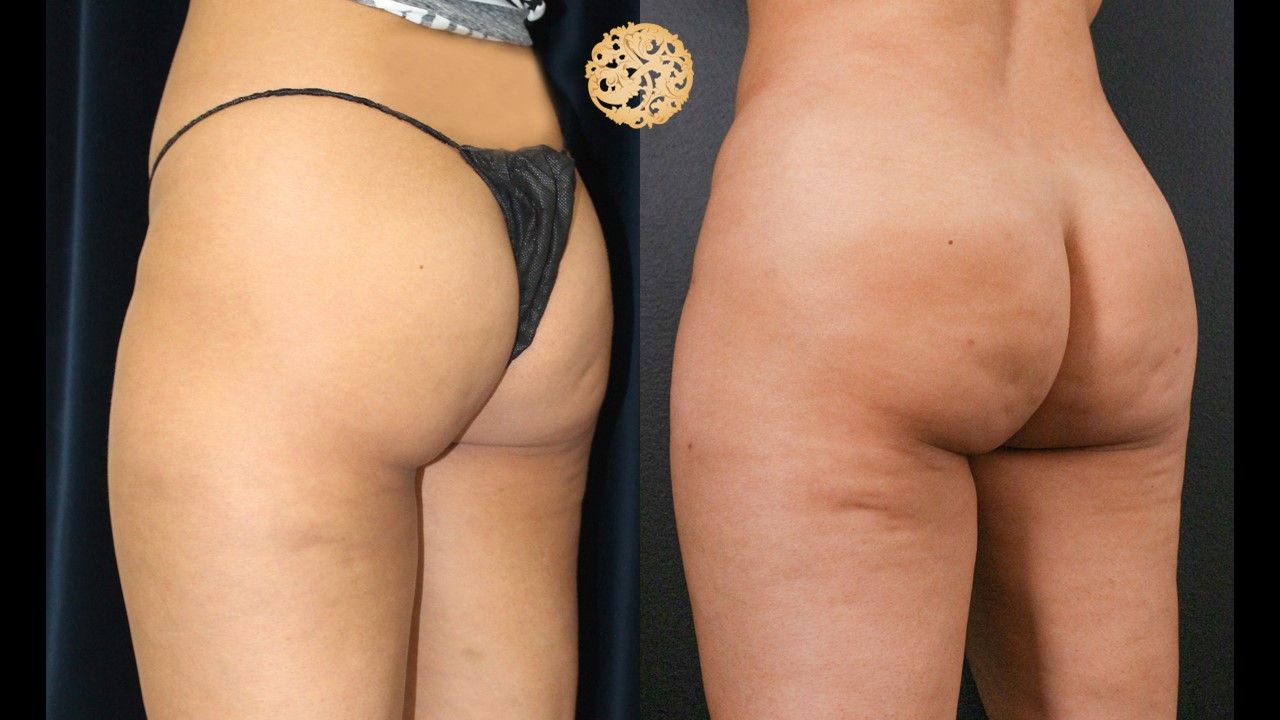Brazilian Butt Lift Before & After