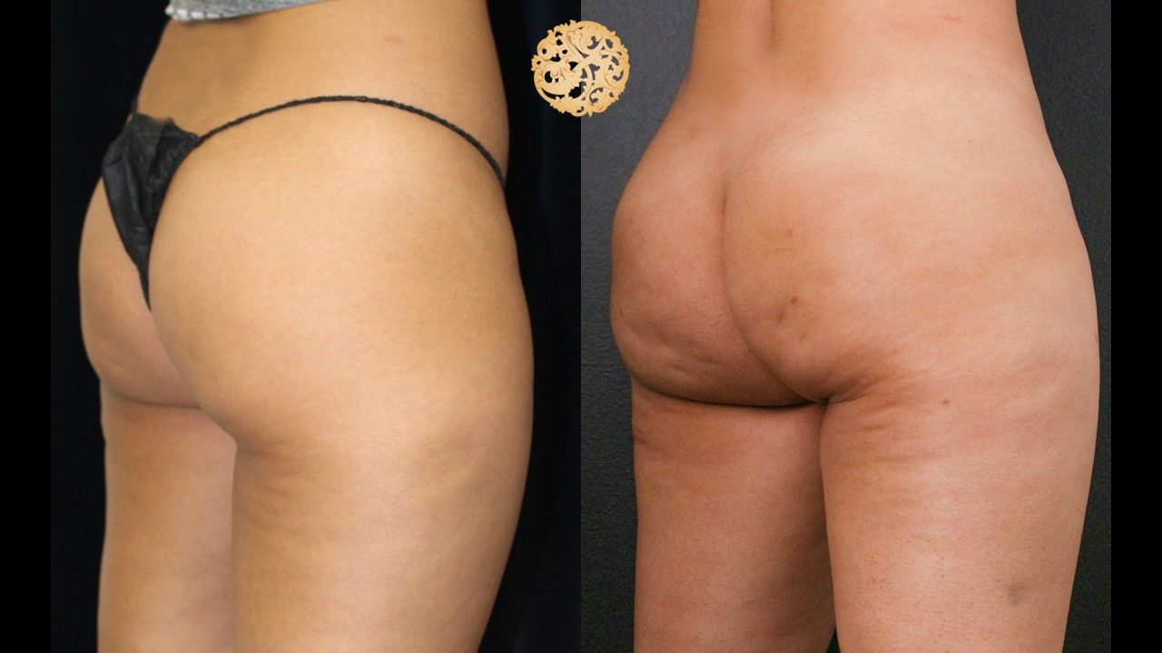 Brazilian Butt Lift Before & After