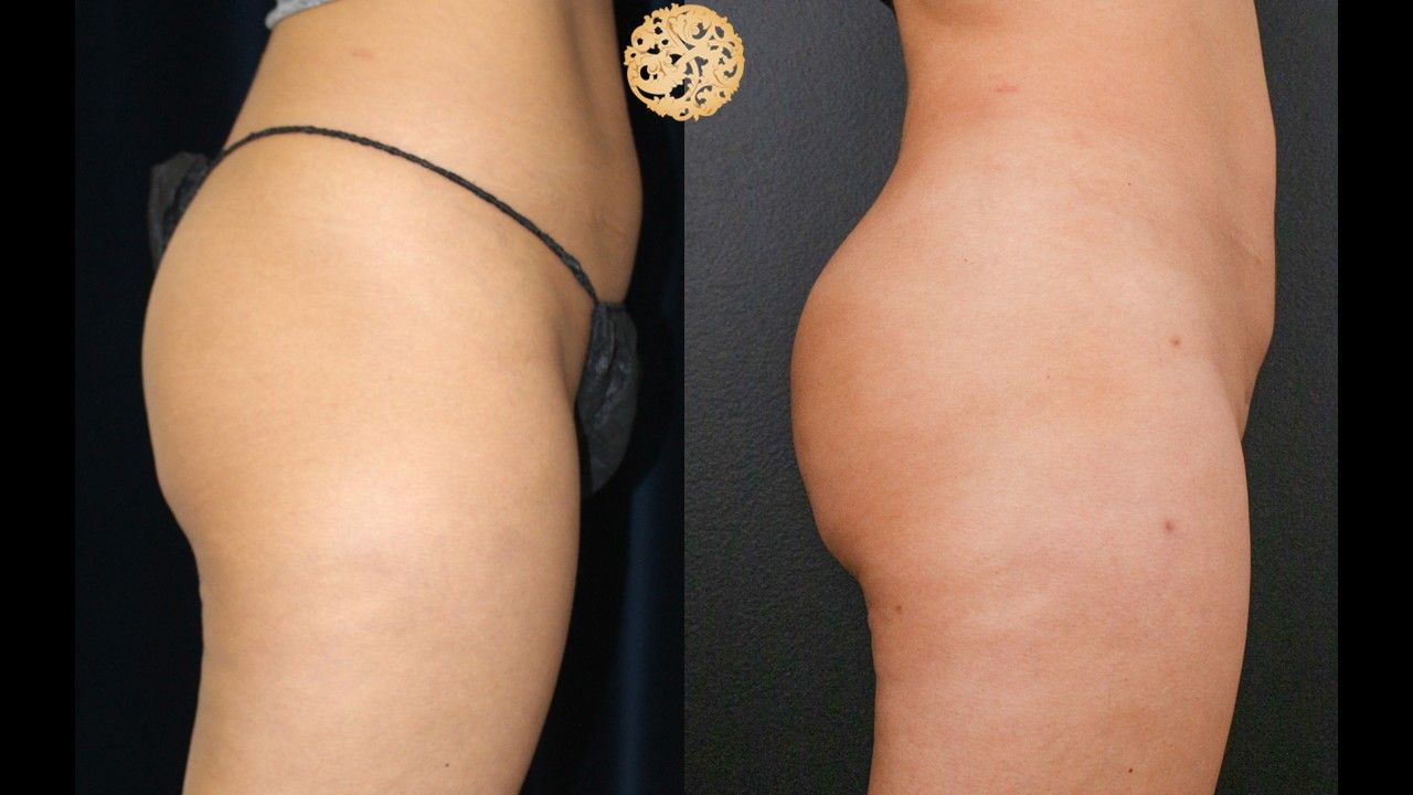 Brazilian Butt Lift Before & After