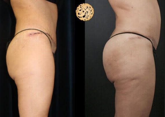 Brazilian Butt Lift Before & After