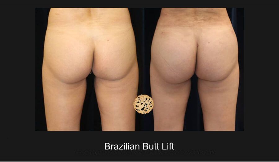 Brazilian Butt Lift Before & After