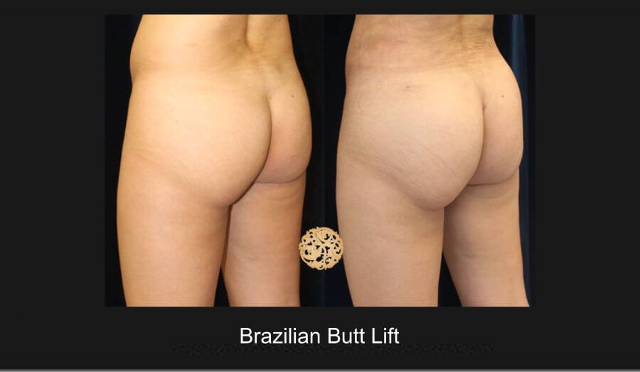 Brazilian Butt Lift Before & After