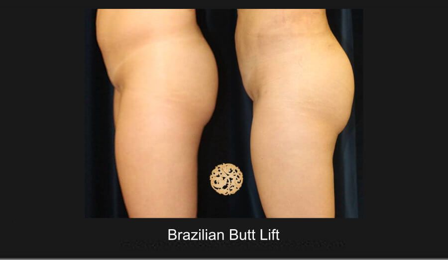 Brazilian Butt Lift Before & After