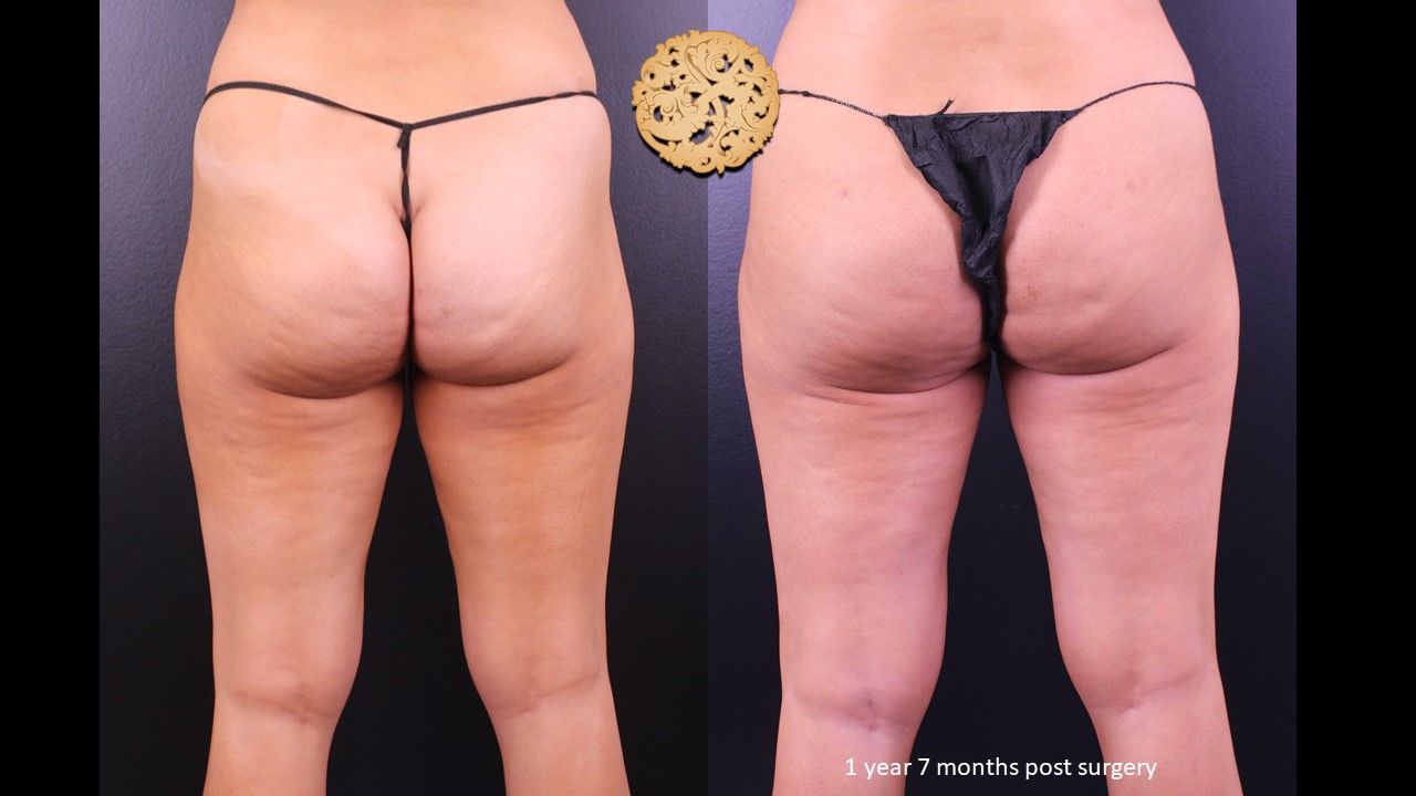 Brazilian Butt Lift Before & After