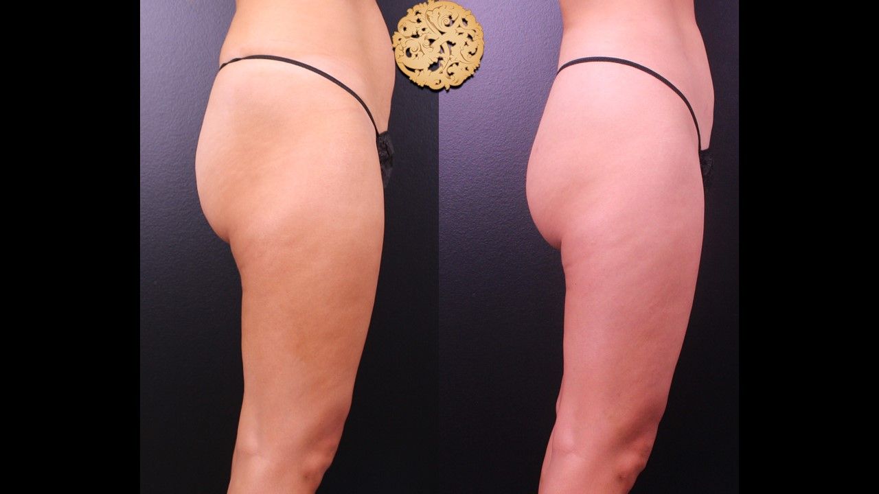Brazilian Butt Lift Before & After