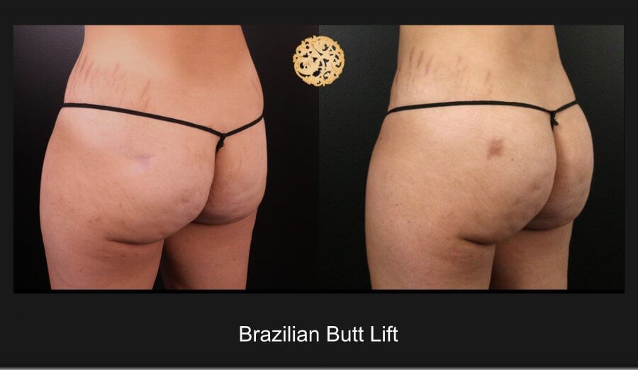 Brazilian Butt Lift Before & After