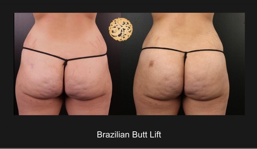 Brazilian Butt Lift Before & After