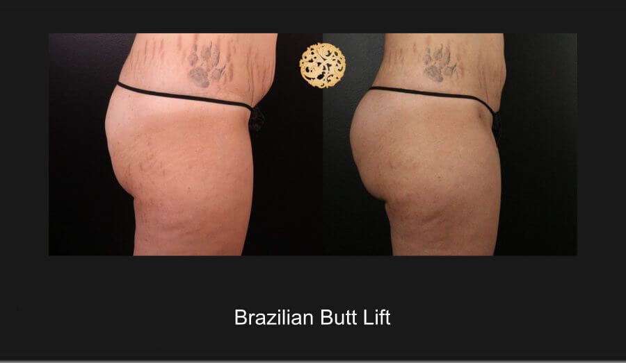 Brazilian Butt Lift Before & After