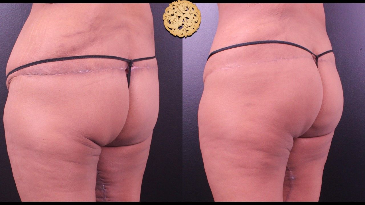 Brazilian Butt Lift Before & After