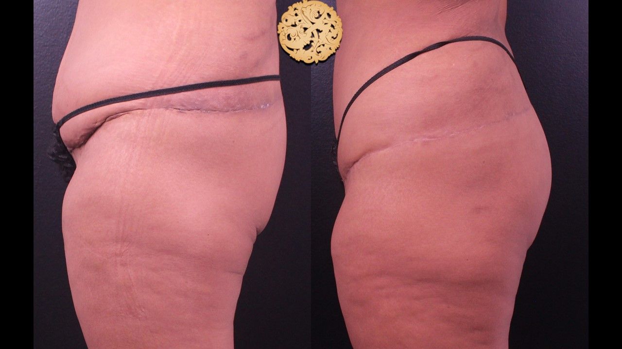 Brazilian Butt Lift Before & After