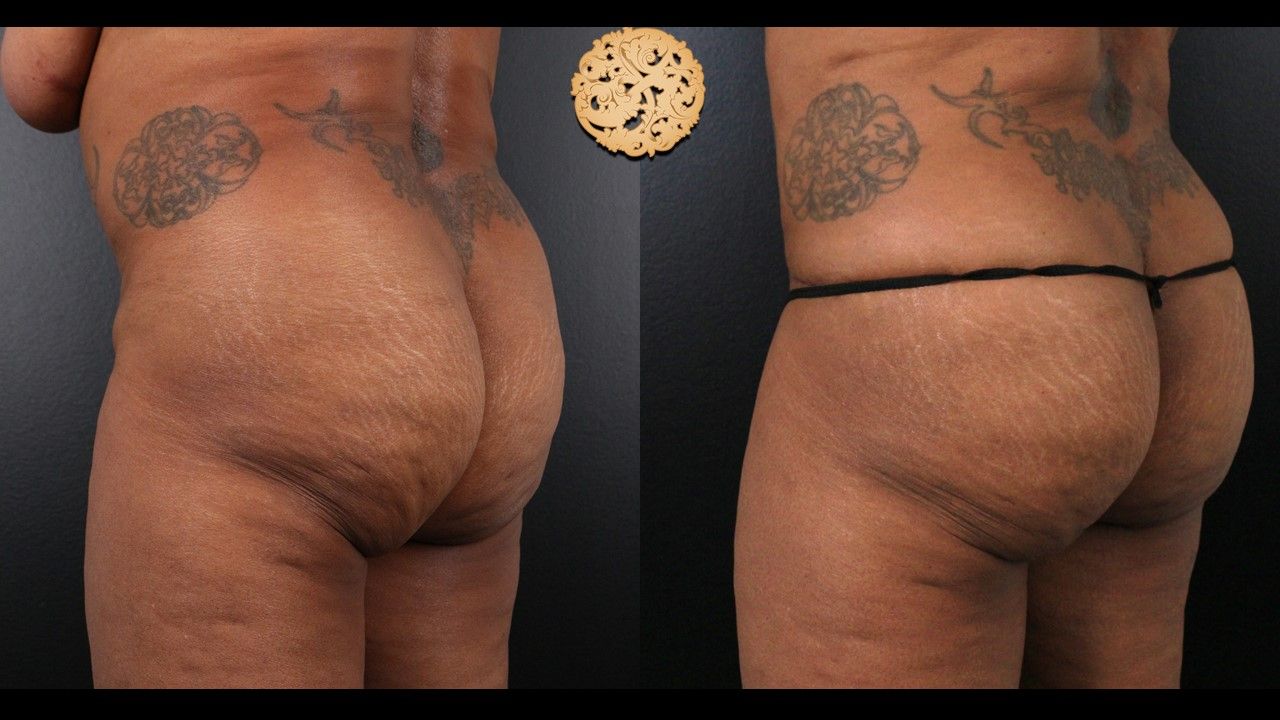 Brazilian Butt Lift Before & After