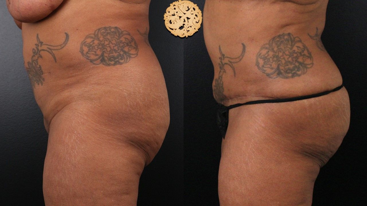 Brazilian Butt Lift Before & After