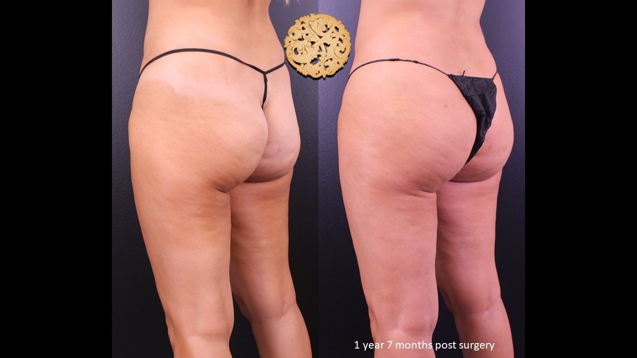 Brazilian Butt Lift Before & After