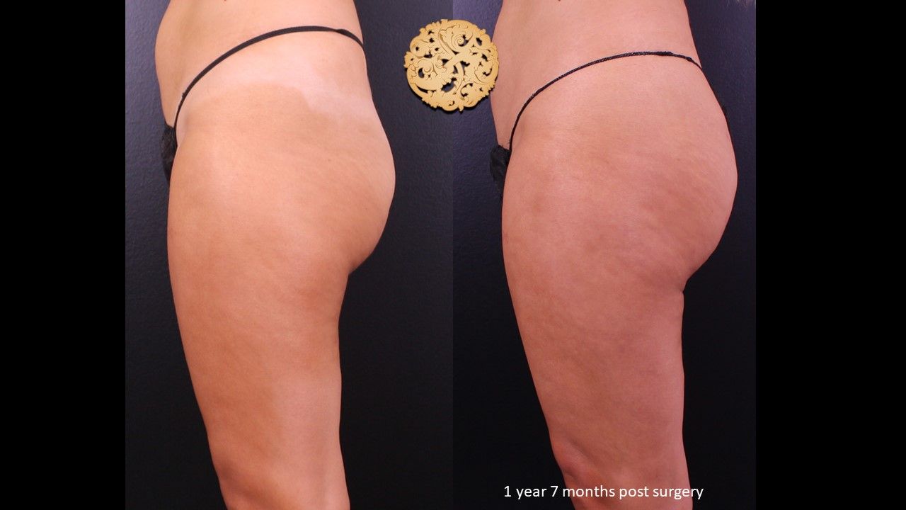 Brazilian Butt Lift Before & After