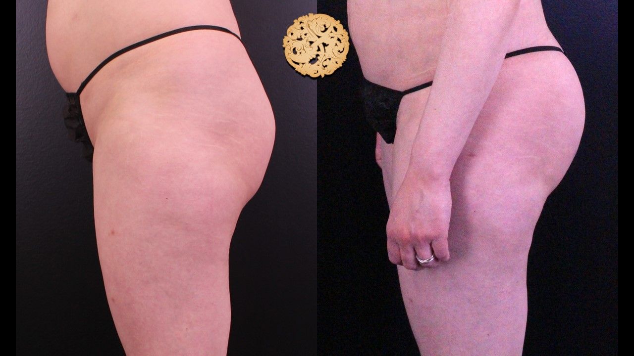 Brazilian Butt Lift Before & After