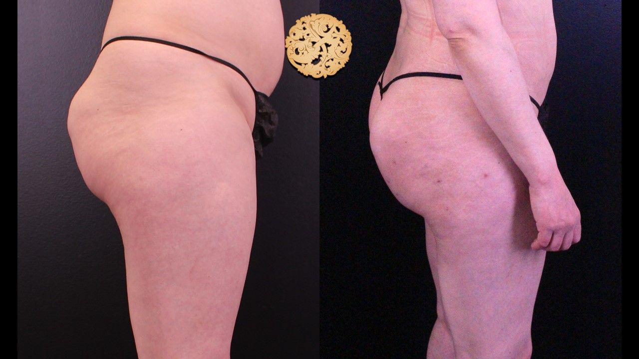 Brazilian Butt Lift Before & After