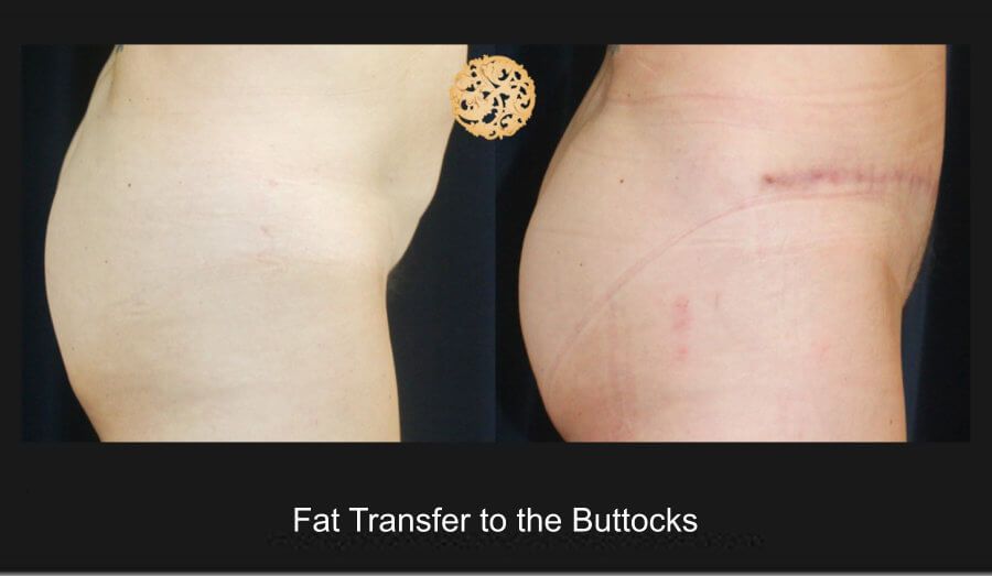 Brazilian Butt Lift Before & After