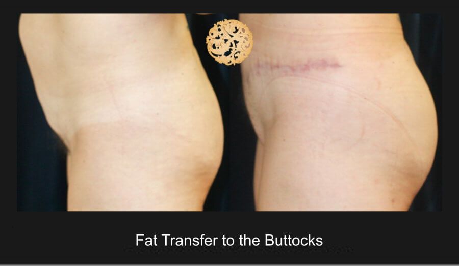 Brazilian Butt Lift Before & After