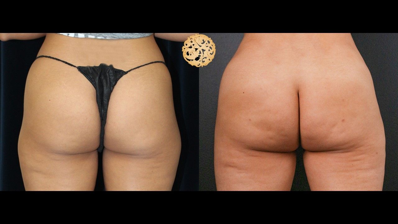 Brazilian Butt Lift Before & After
