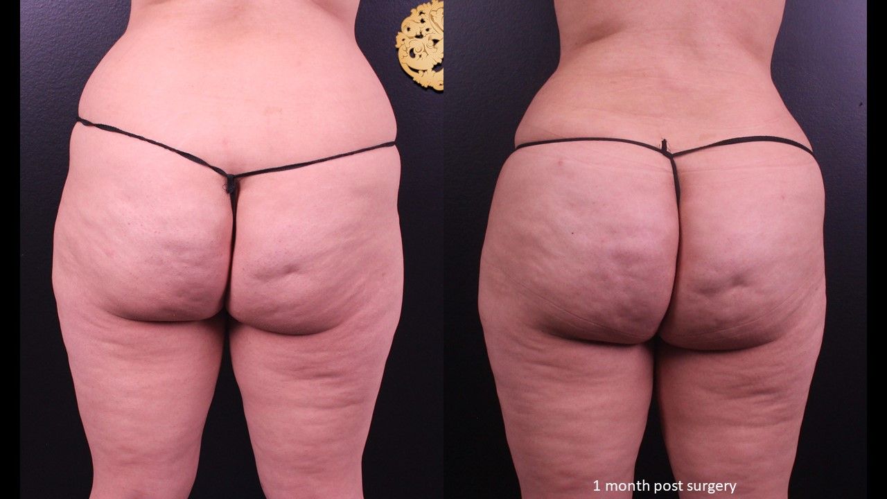 Brazilian Butt Lift Before & After