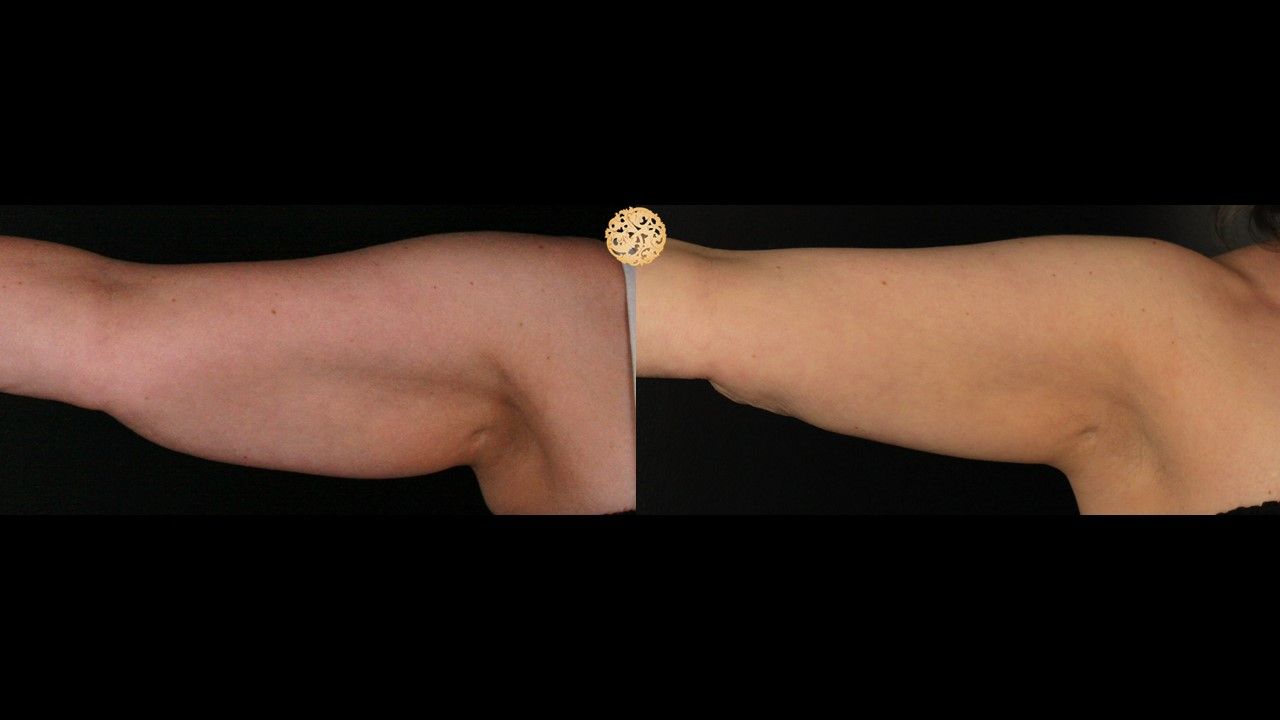 Coolsculpting Arms Before & After