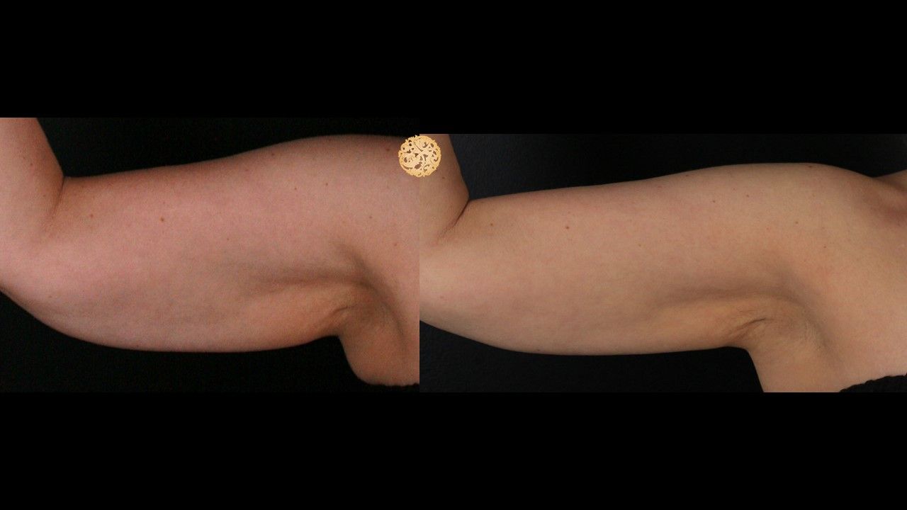 Coolsculpting Arms Before & After