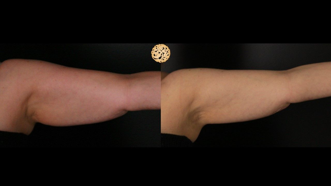 Coolsculpting Arms Before & After