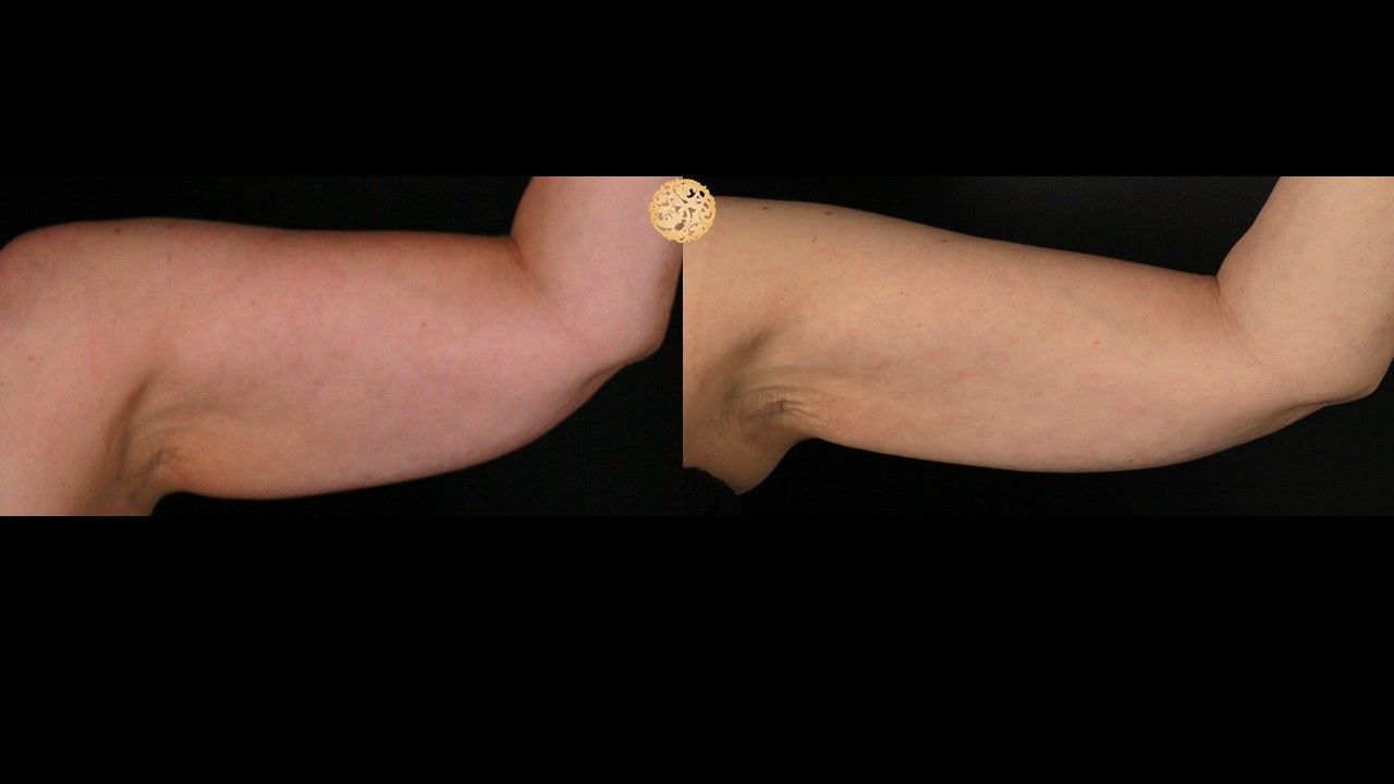 Coolsculpting Arms Before & After