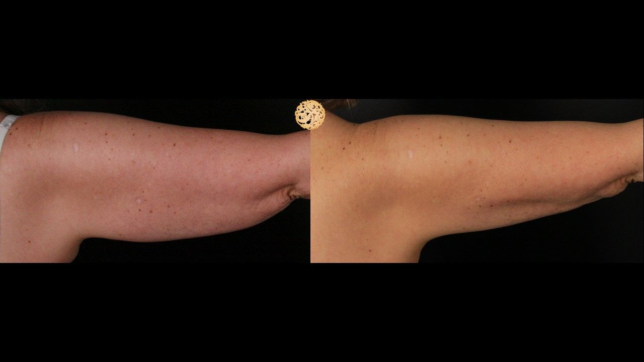 Coolsculpting Arms Before & After
