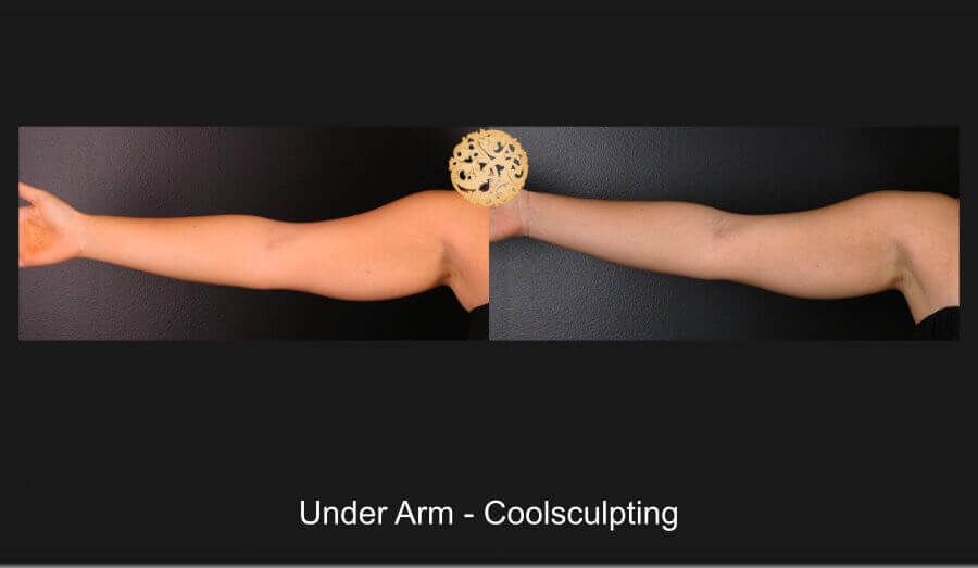 Coolsculpting Arms Before & After
