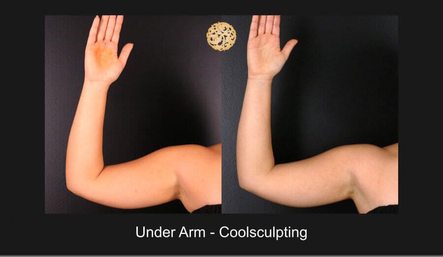 Coolsculpting Arms Before & After