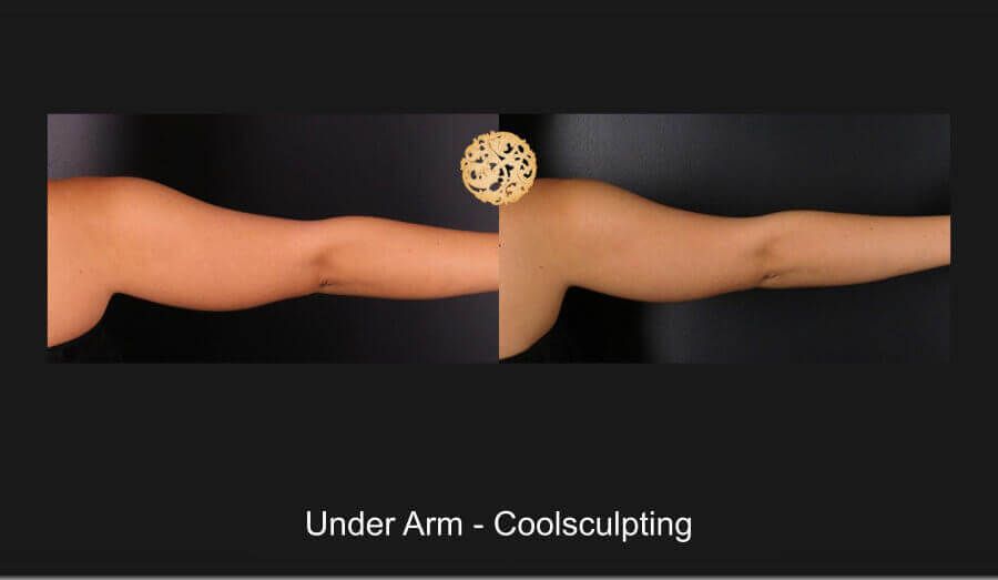 Coolsculpting Arms Before & After