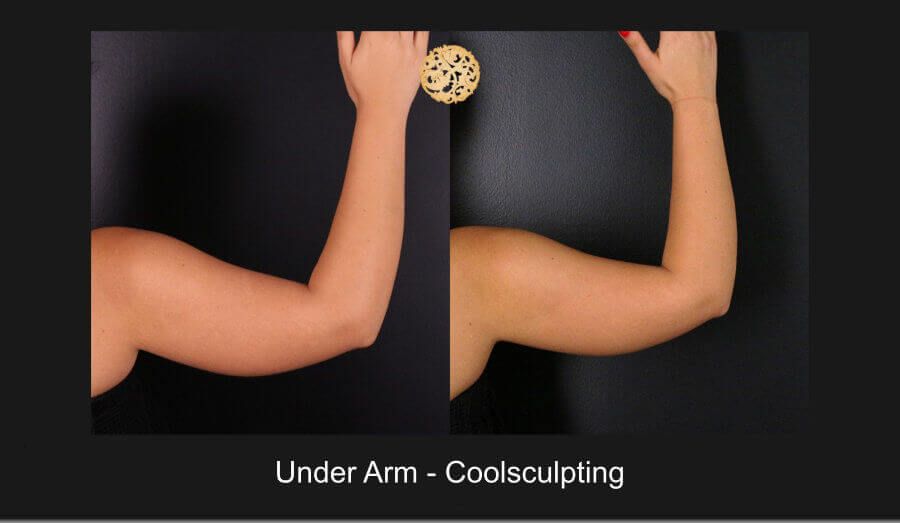 Coolsculpting Arms Before & After