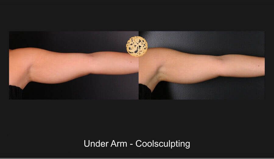 Coolsculpting Arms Before & After