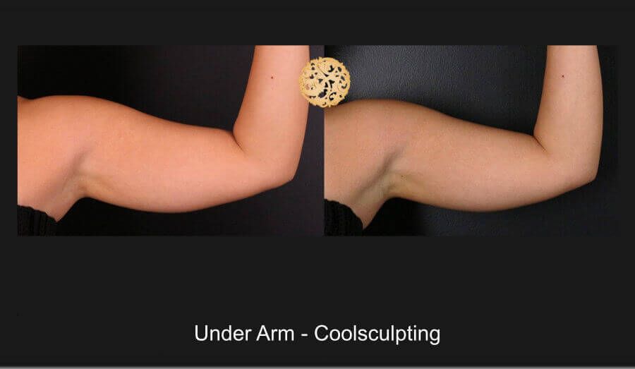Coolsculpting Arms Before & After