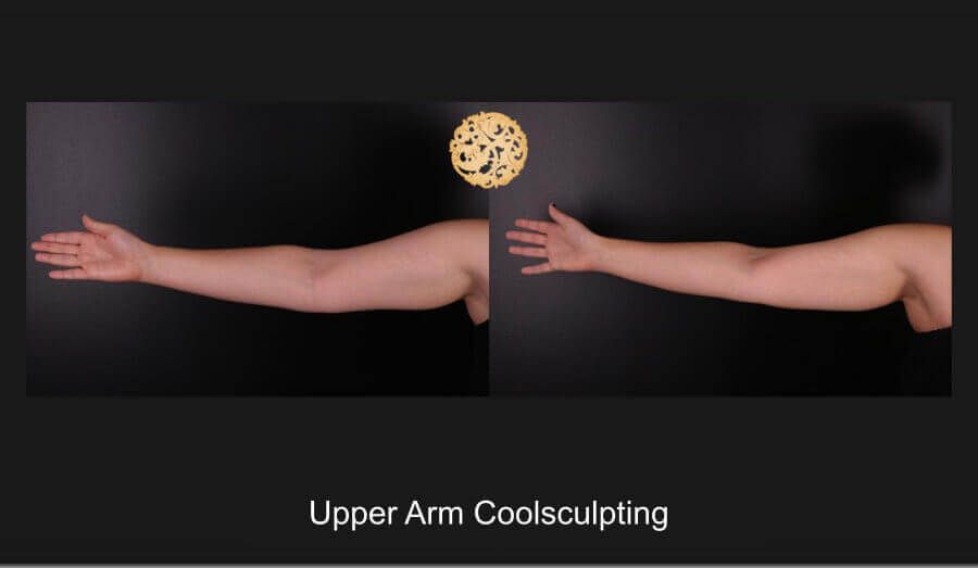 Coolsculpting Arms Before & After
