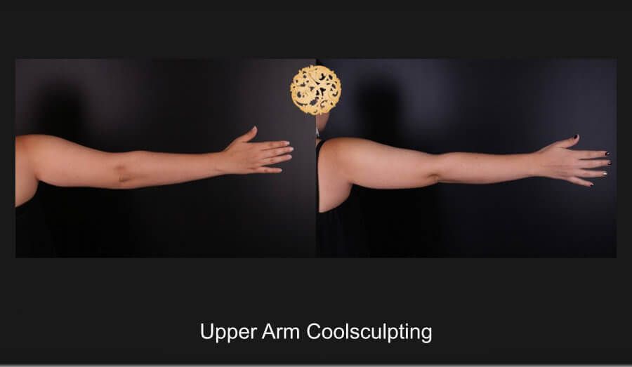 Coolsculpting Arms Before & After