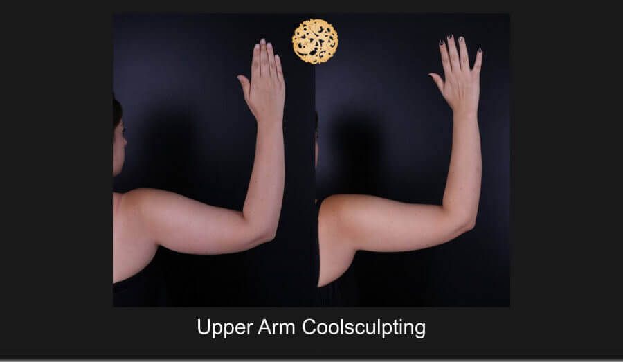 Coolsculpting Arms Before & After