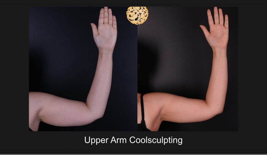 Coolsculpting Arms Before & After