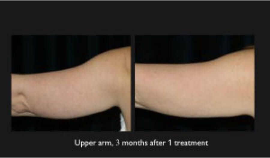 Coolsculpting Arms Before & After