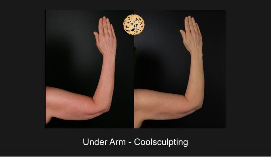 Coolsculpting Arms Before & After