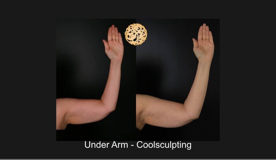 Coolsculpting Arms Before & After