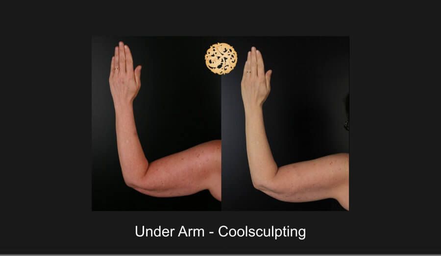 Coolsculpting Arms Before & After