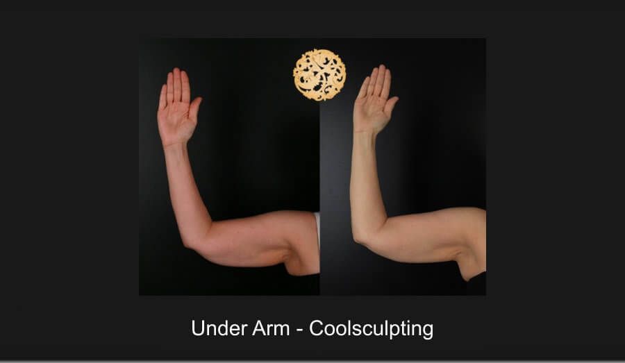 Coolsculpting Arms Before & After