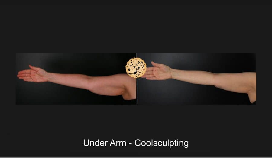 Coolsculpting Arms Before & After
